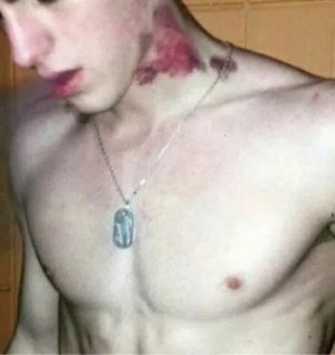Удивительный случай: инсульт после поцелуя стал трагедией