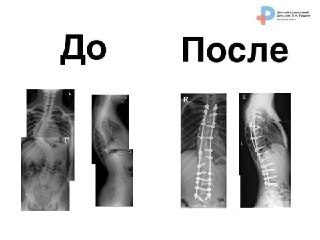 Успех хирургов: девочка избавилась от сколиоза IV степени