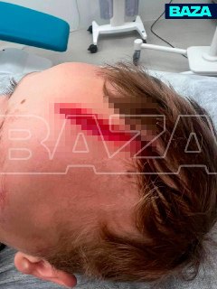 Собака атаковала 7-летнего мальчика в селе Дубцы